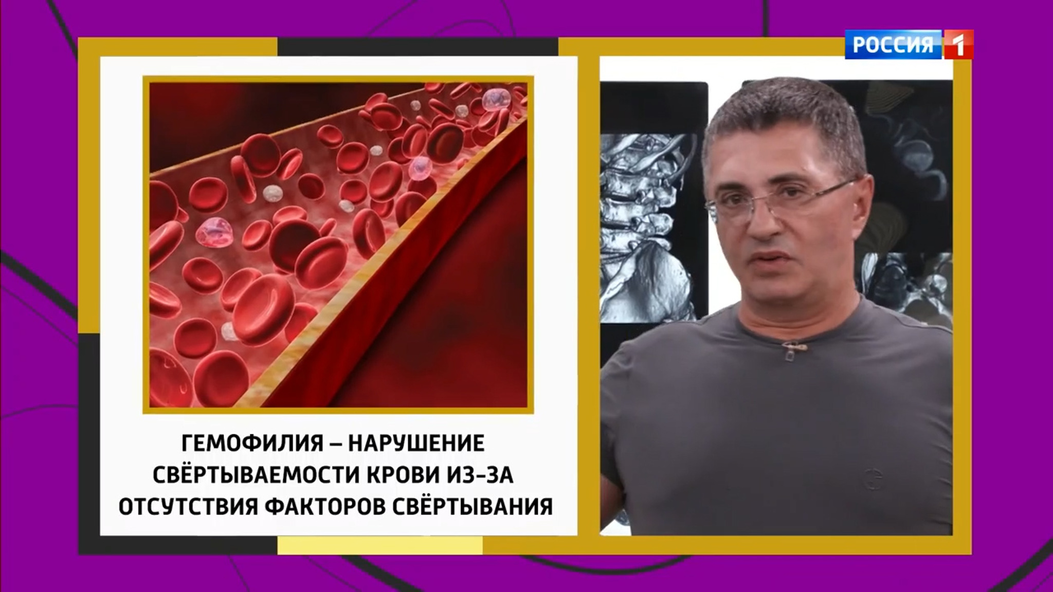 Как связаны синяки и боль в суставах, рассказал Мясников