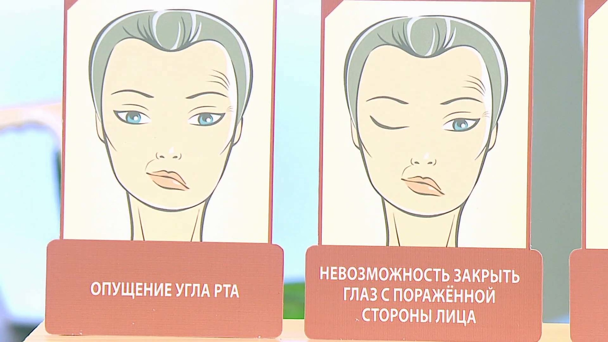 Как отличить паралич лицевого нерва от инсульта: советы доктора Мясникова