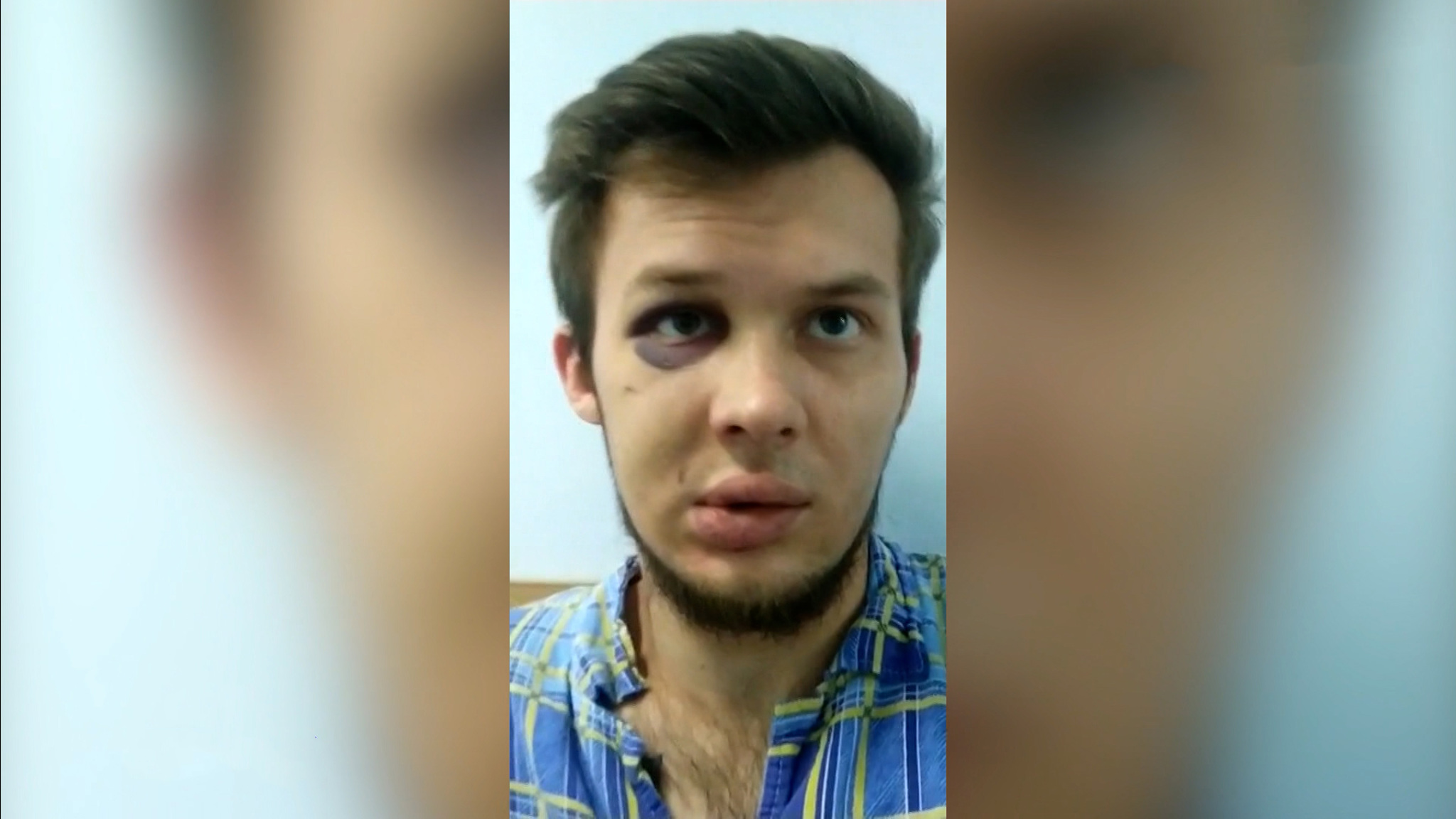Самокат помешал машине бойца ММА: встреча закончилась переломом основания черепа