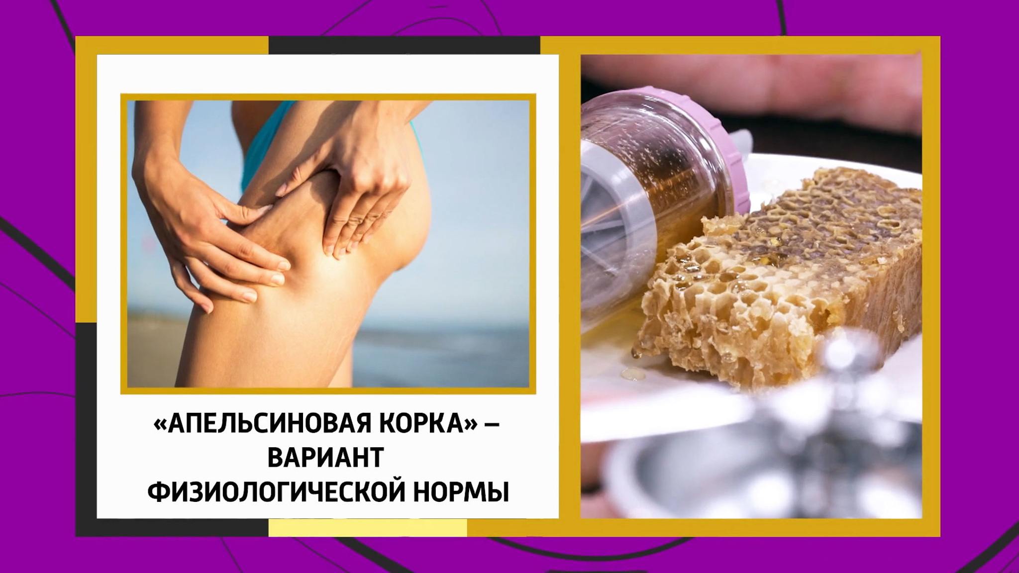 Александр Мясников развеял мифы о целлюлите