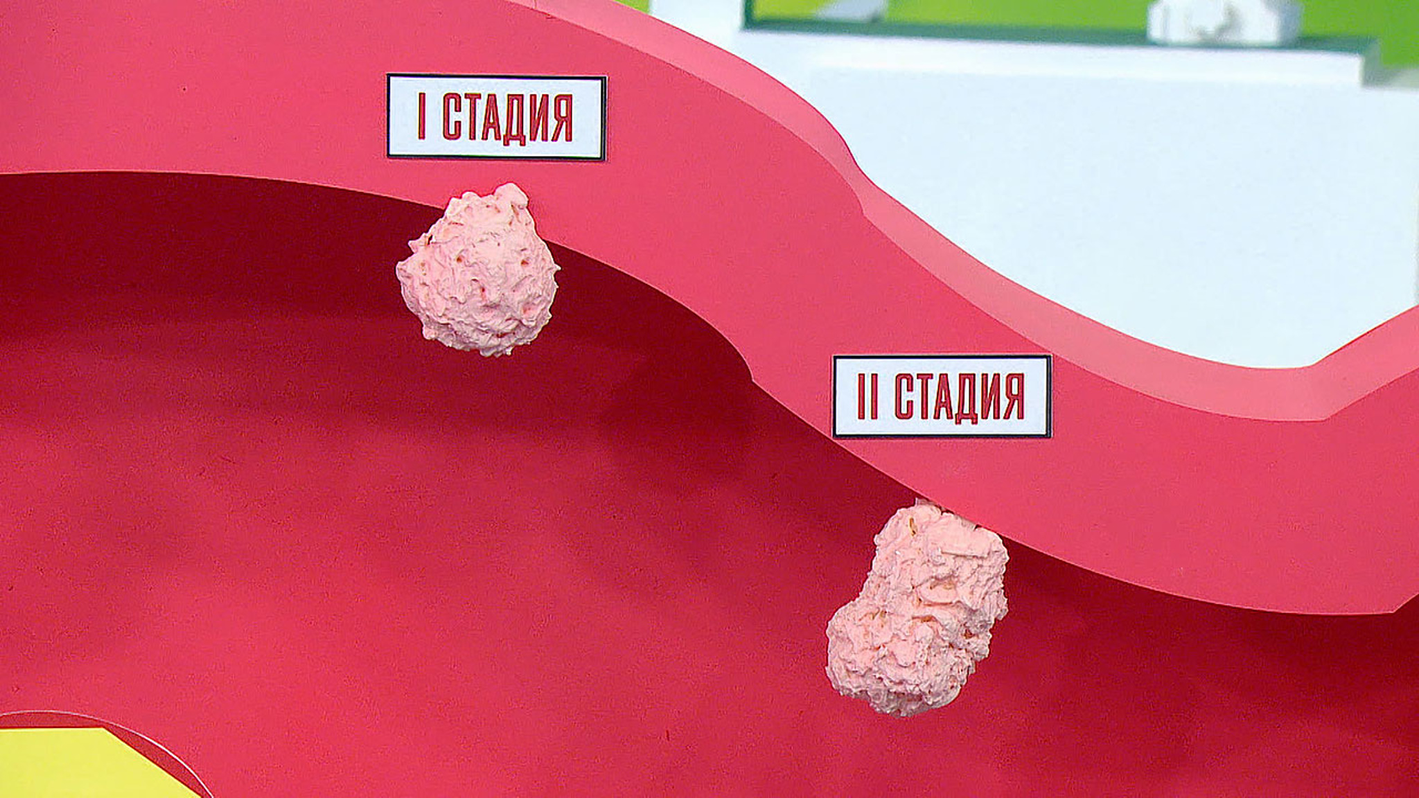 Мясников назвал факторы риска развития рака кишечника