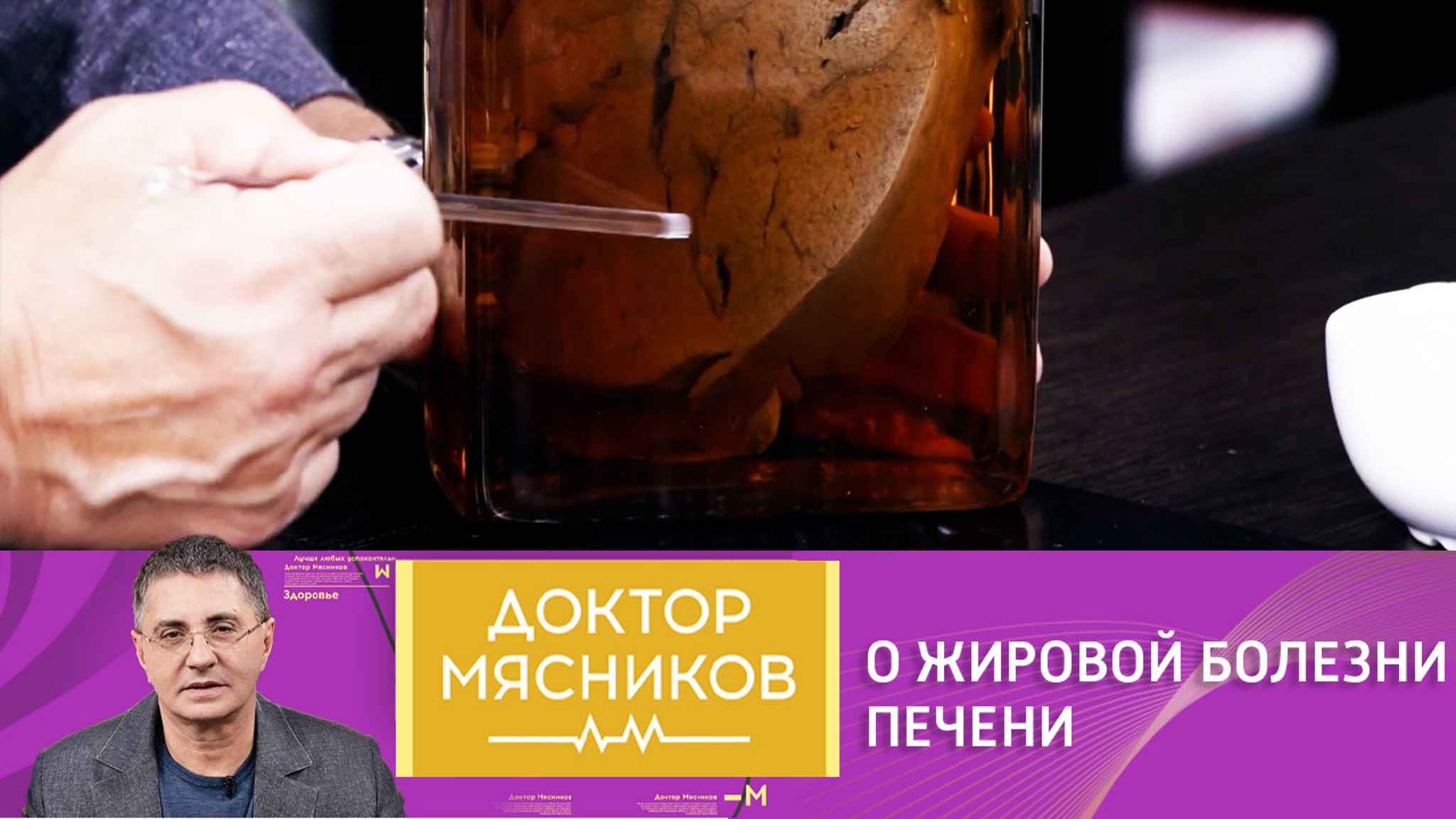 Мясников рассказал о неалкогольной жировой болезни печени