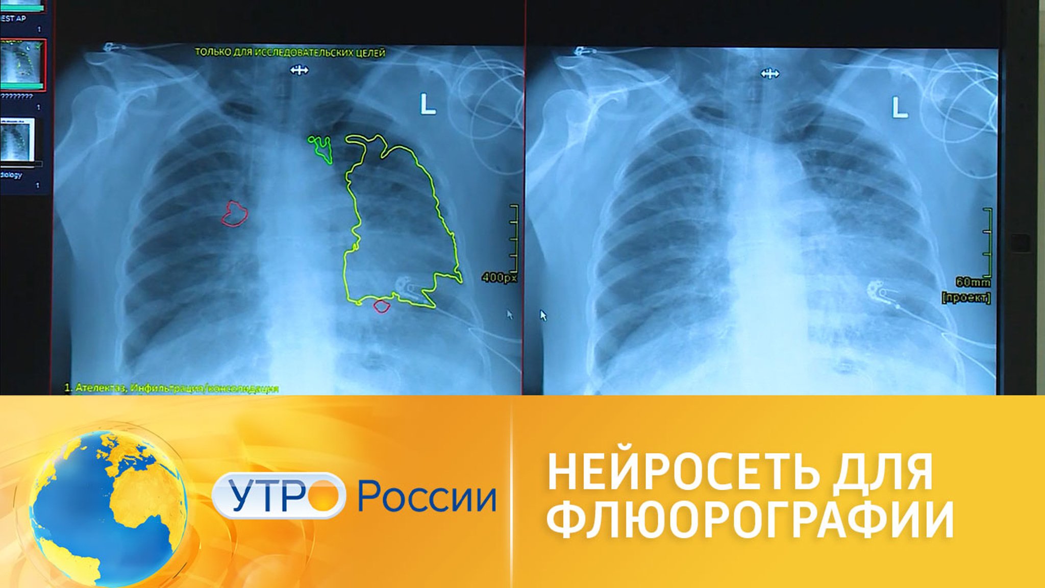 Нейросеть вычисляет заболевания по флюрографии