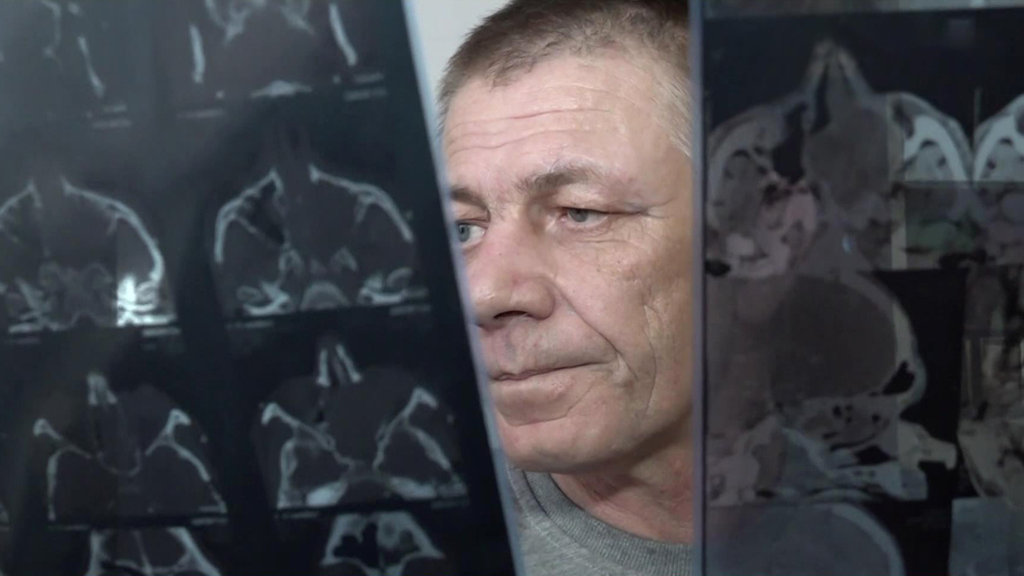 В Екатеринбурге хирурги удалили пациенту постковидную ангиофиброму