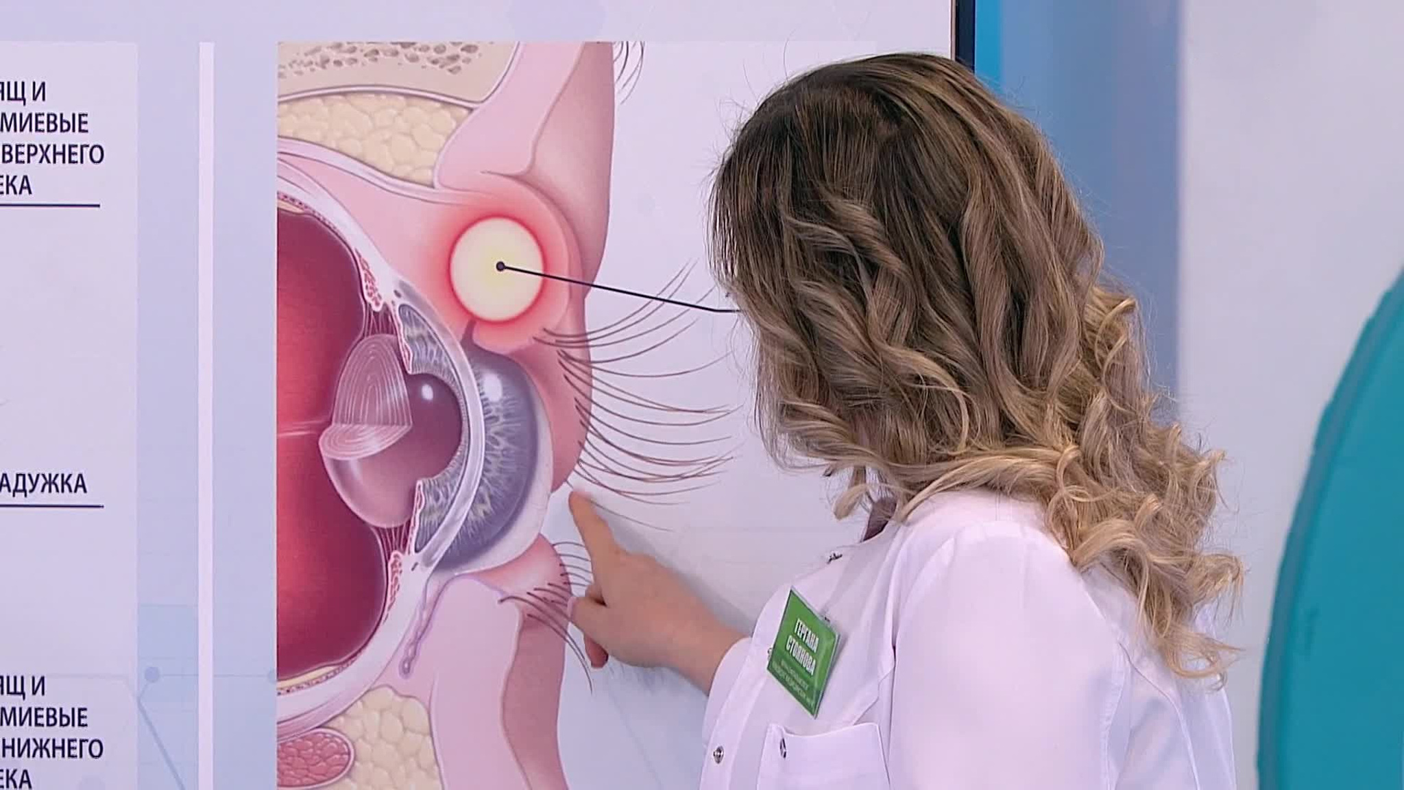 Причины появления халязиона глазного века и способы лечения