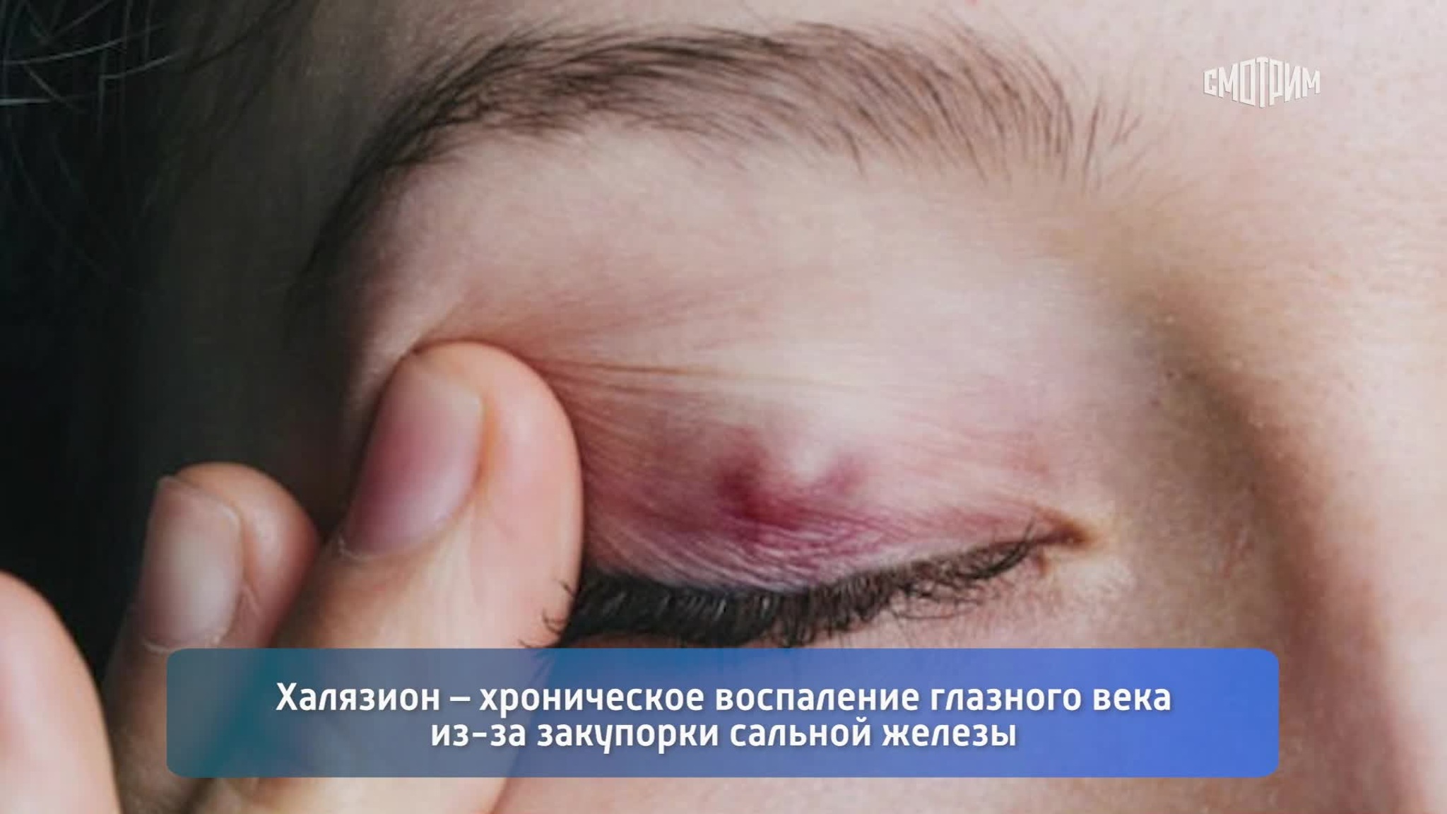 Что такое халязион и чем отличается от ячменя