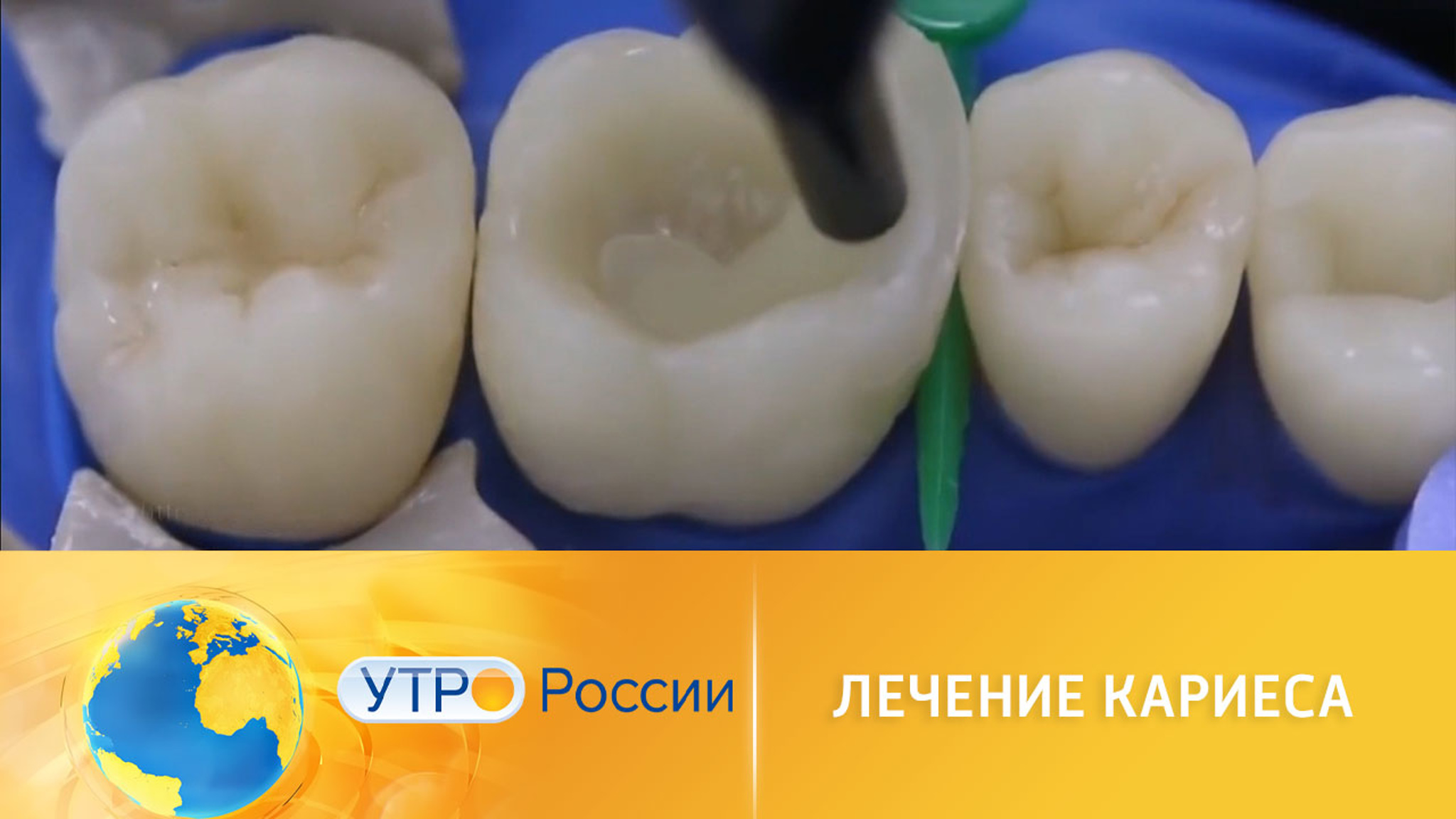 Вечные пломбы: уникальная методика лечения кариеса