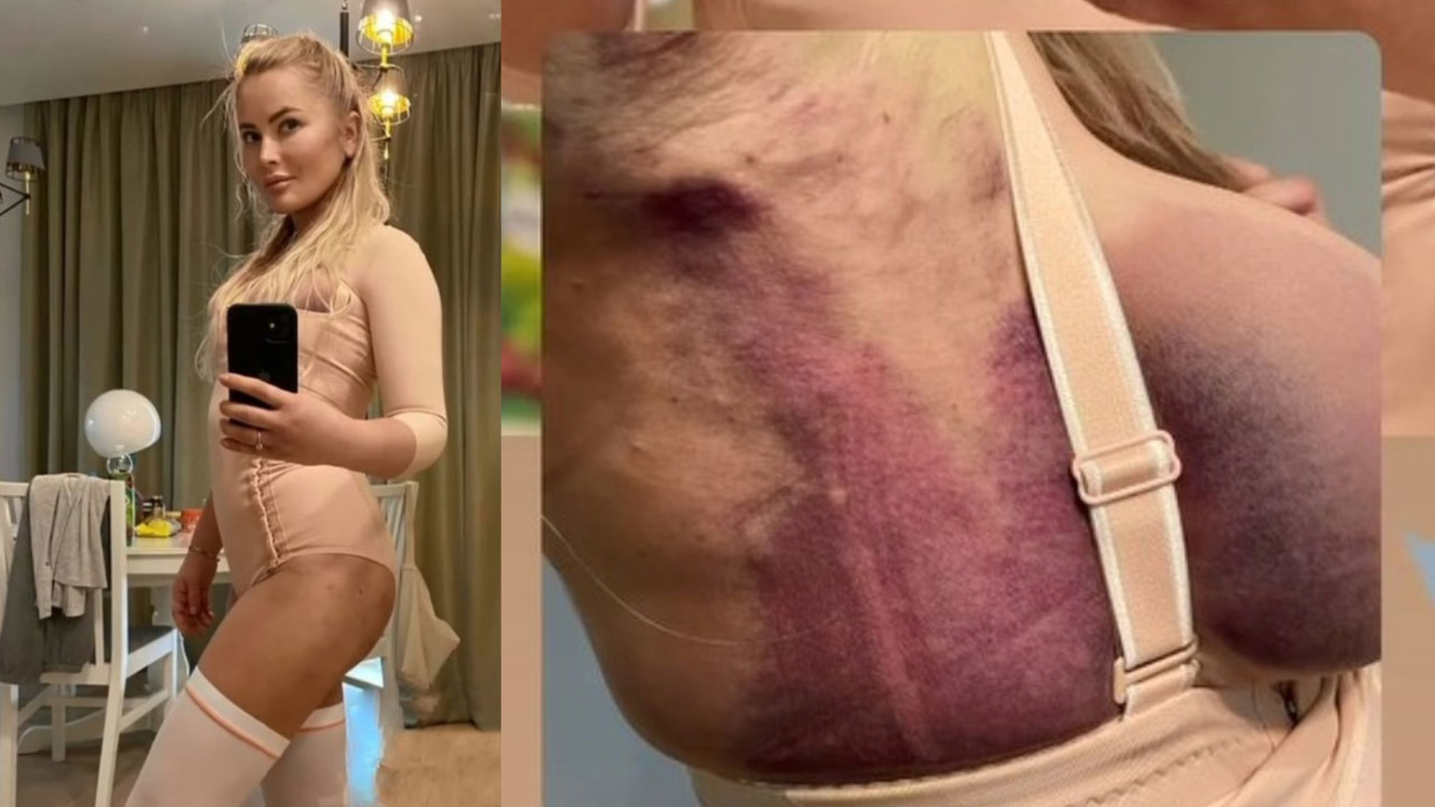 Дана Борисова показала "честные" снимки после пластики