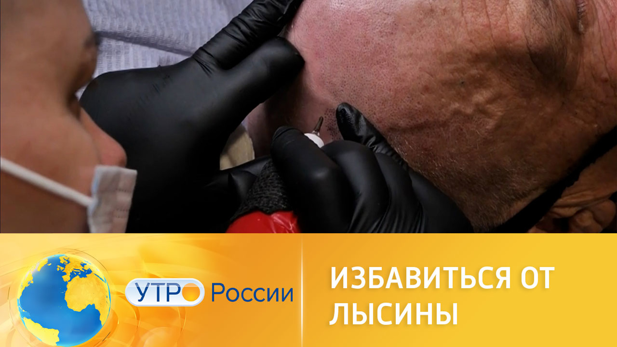 Что нового в области борьбы с облысением