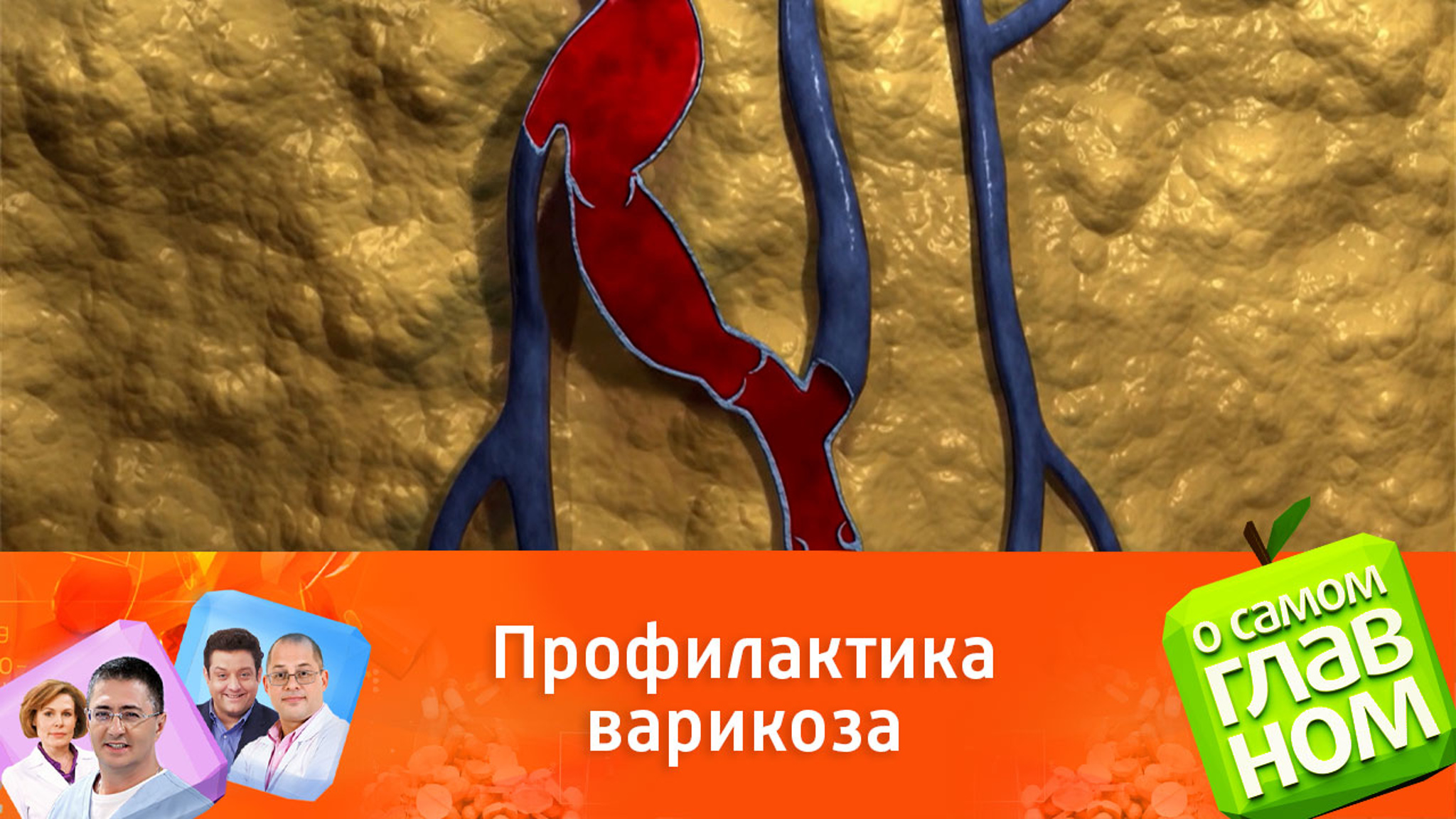 Варикозное расширение вен: как его избежать