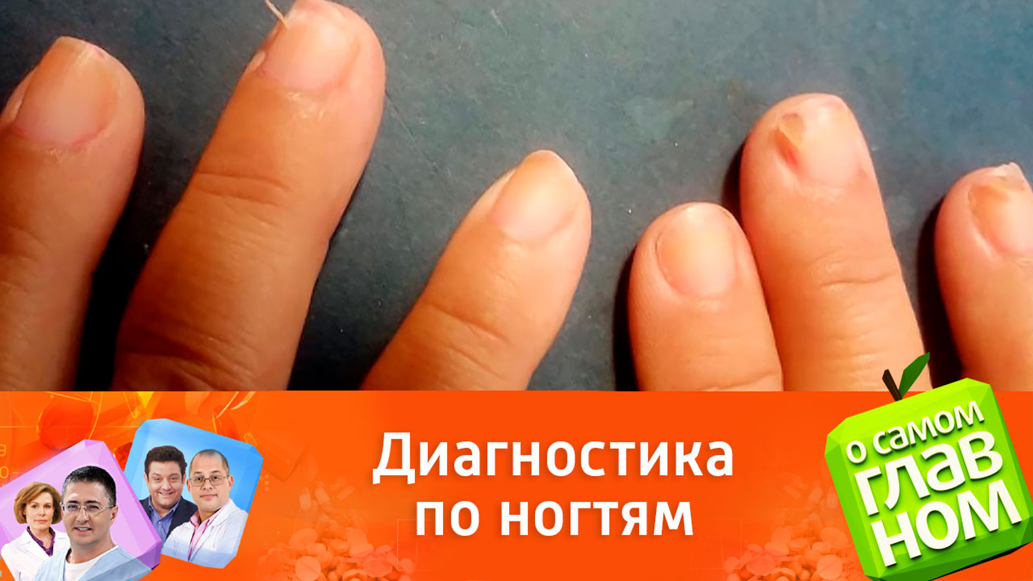 О каких заболеваниях говорит состояние ногтей
