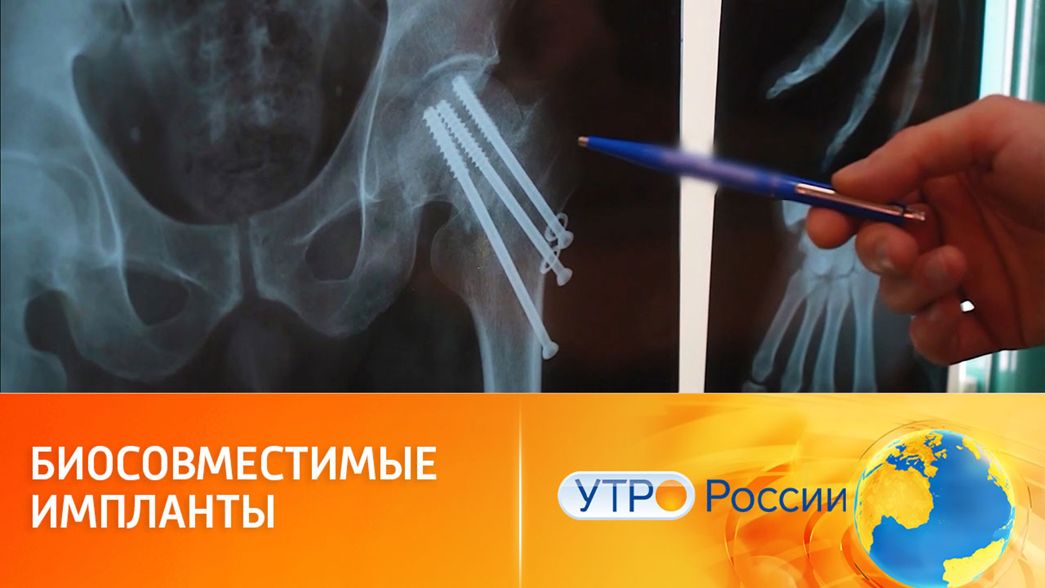 Кости (новые материалы для лечения патологий суставов и костной ткани человека)