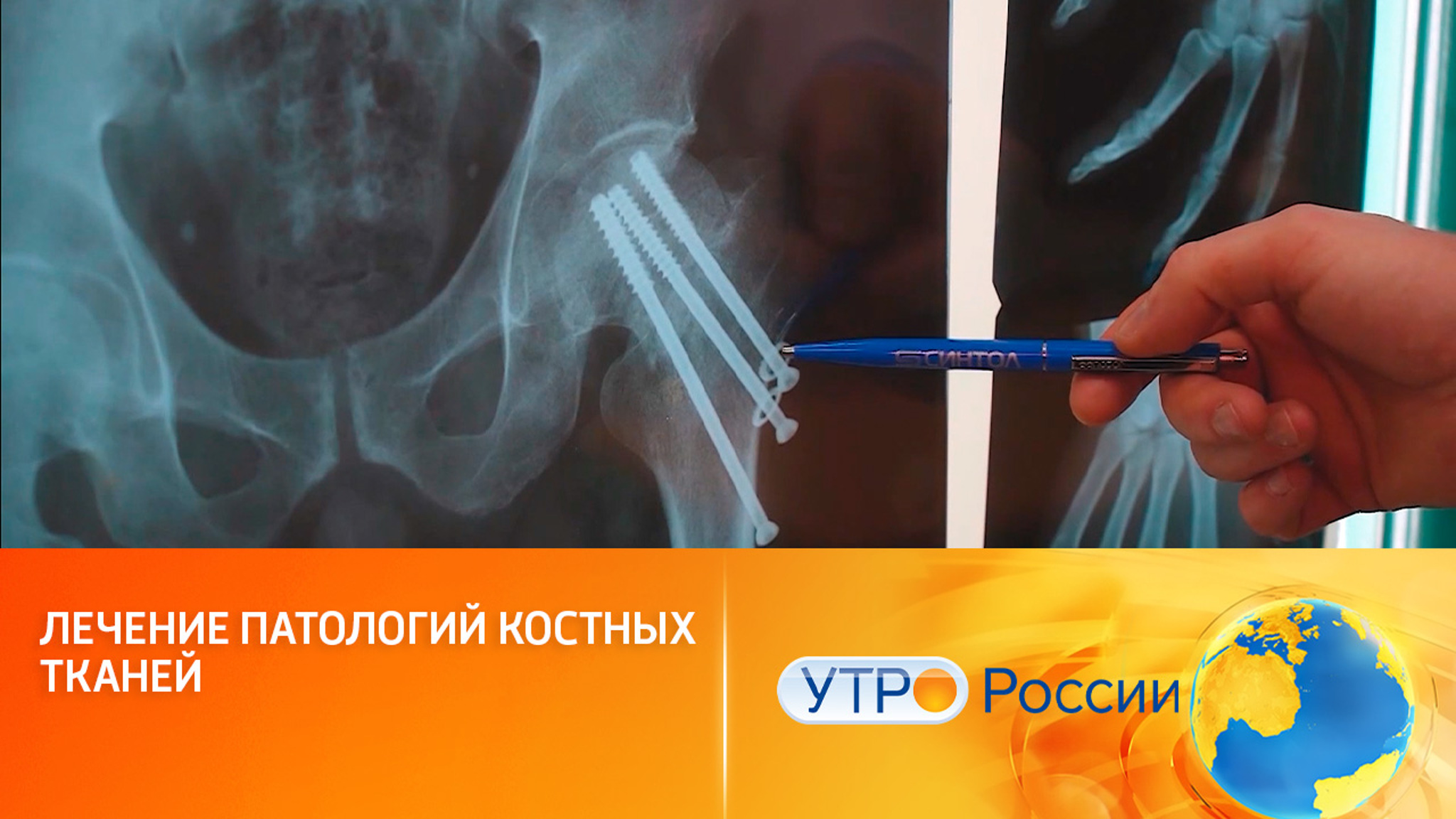 Новые биосовместимые титановые металлоконструкции и имплантаты