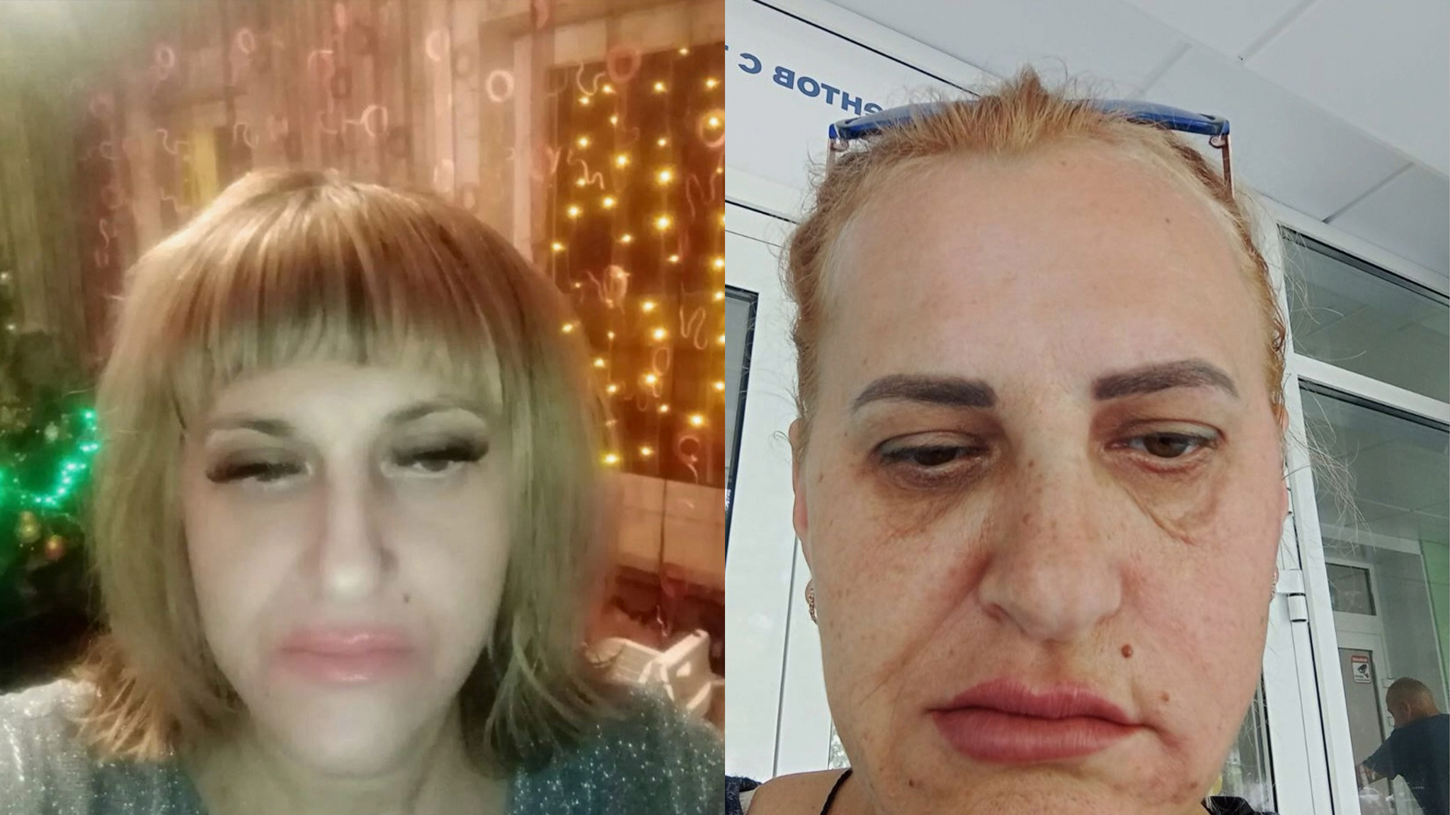 Лжекосметолог превратила жизнь женщины в кошмар: "8,5 месяцев мучений"