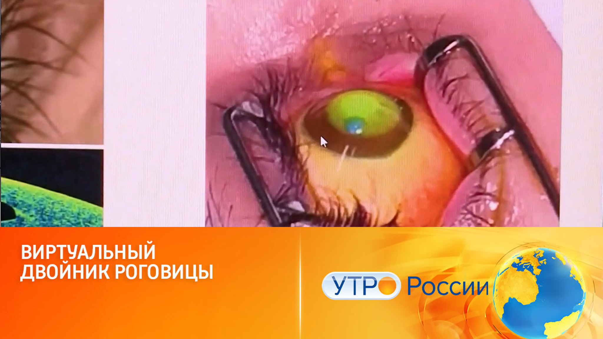 Виртуальный двойник роговицы