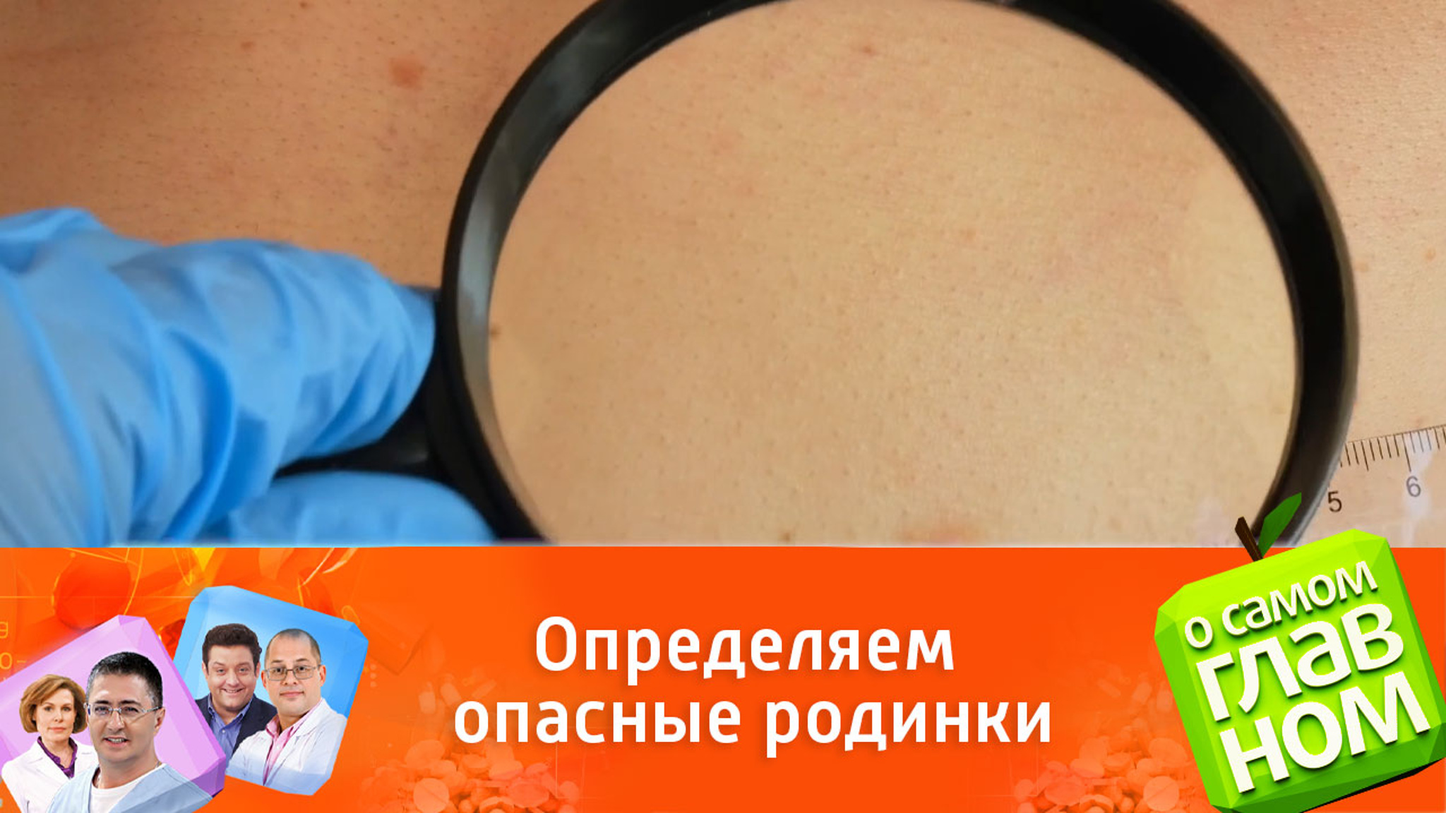 Как понять, какие родинки опасны?