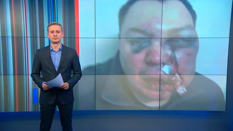 Синяки, гематомы, смещение носа: методы политической борьбы в Иркутской области