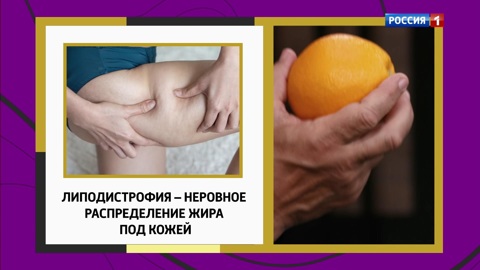 Целлюлит – норма или патология?