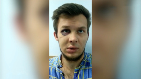 Самокат помешал машине бойца ММА: встреча закончилась переломом основания черепа