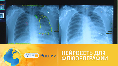 Нейросеть вычисляет заболевания по флюрографии