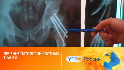 Новые биосовместимые титановые металлоконструкции и имплантаты