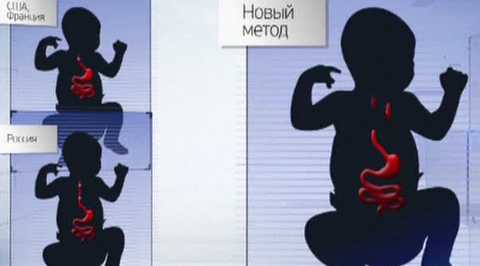 В Москве младенцу "вырастили" отсутствующий пищевод