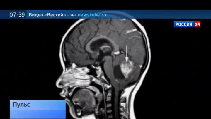Своевременная диагностика рака: головная боль - это повод для обследование