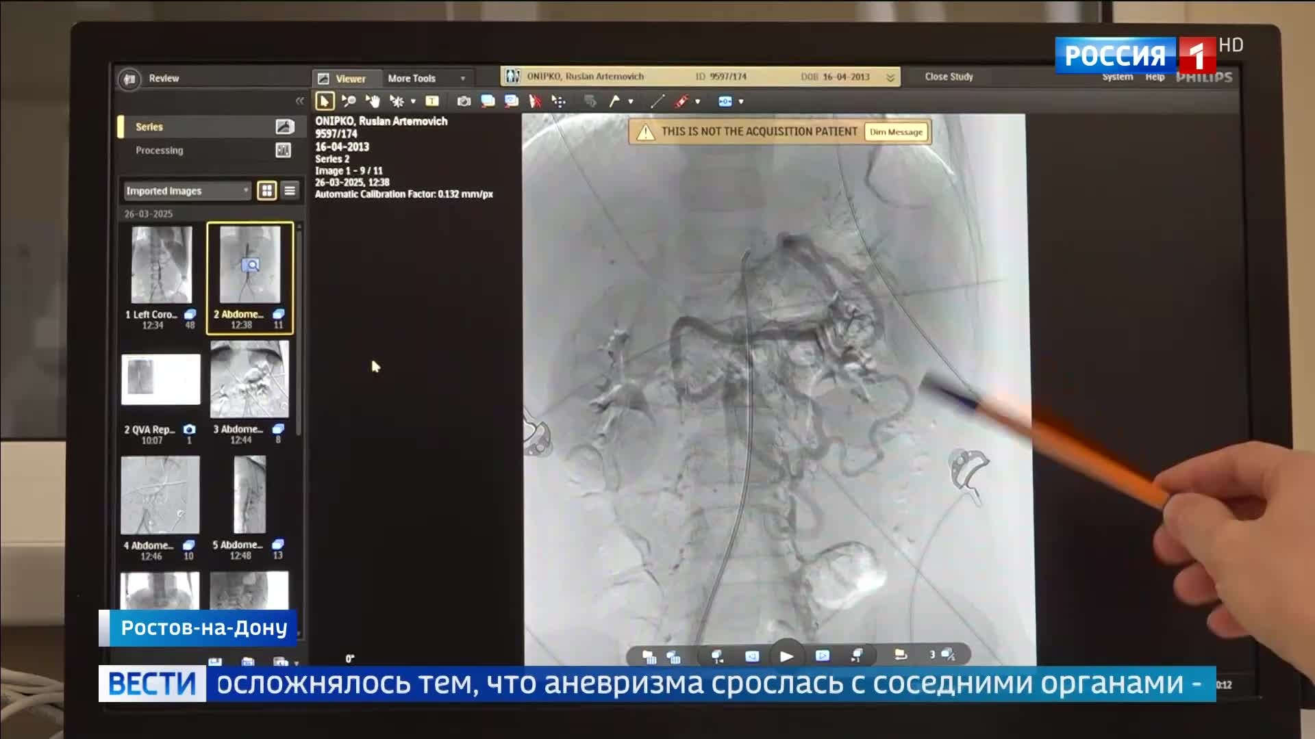"Спасение жизни: редкая операция в Ростове-на-Дону"