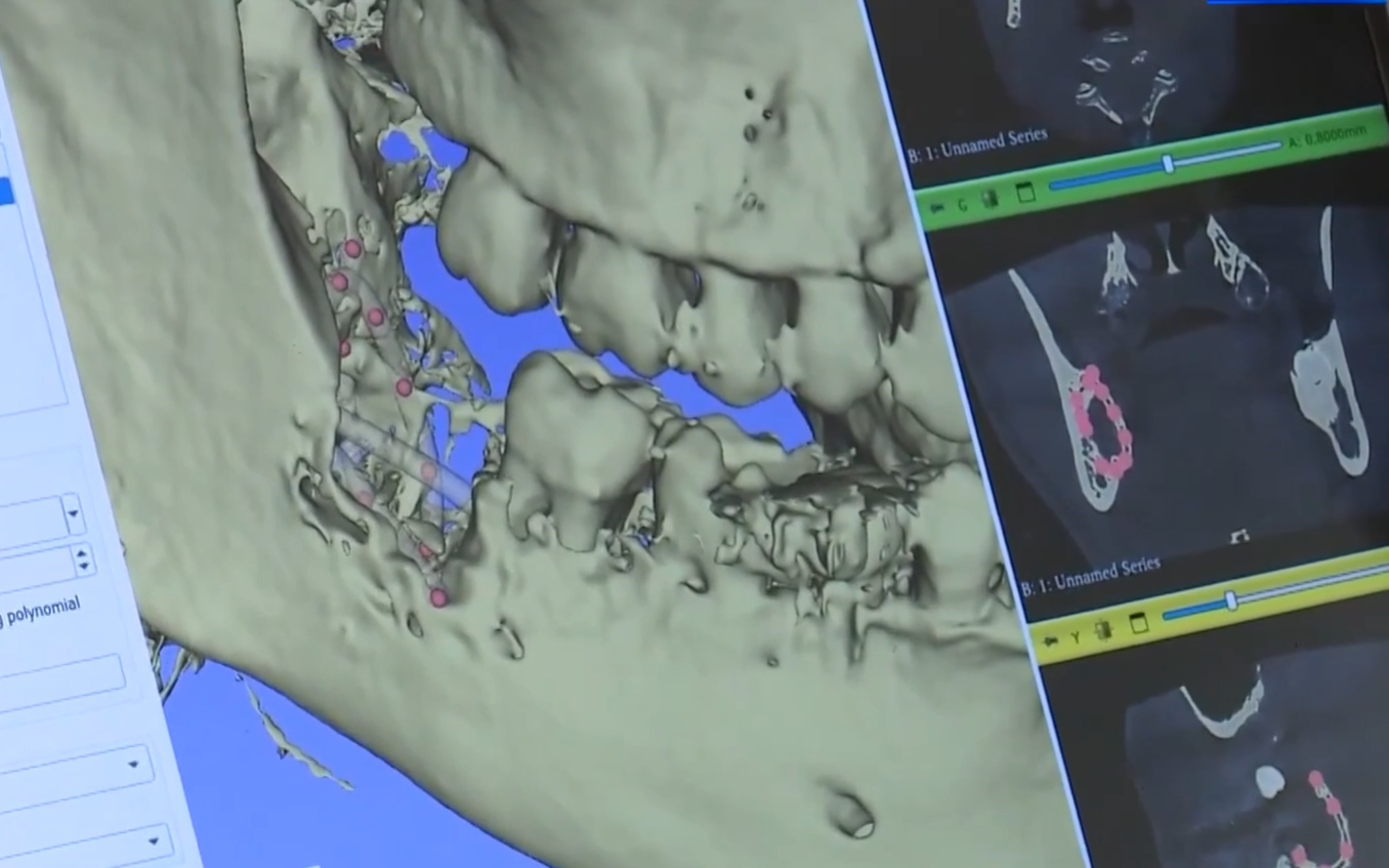 Помощь при пародонтозе